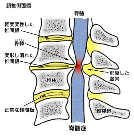 頚椎症 | 人形町整形外科ペイン•リハビリクリニック(整形外科